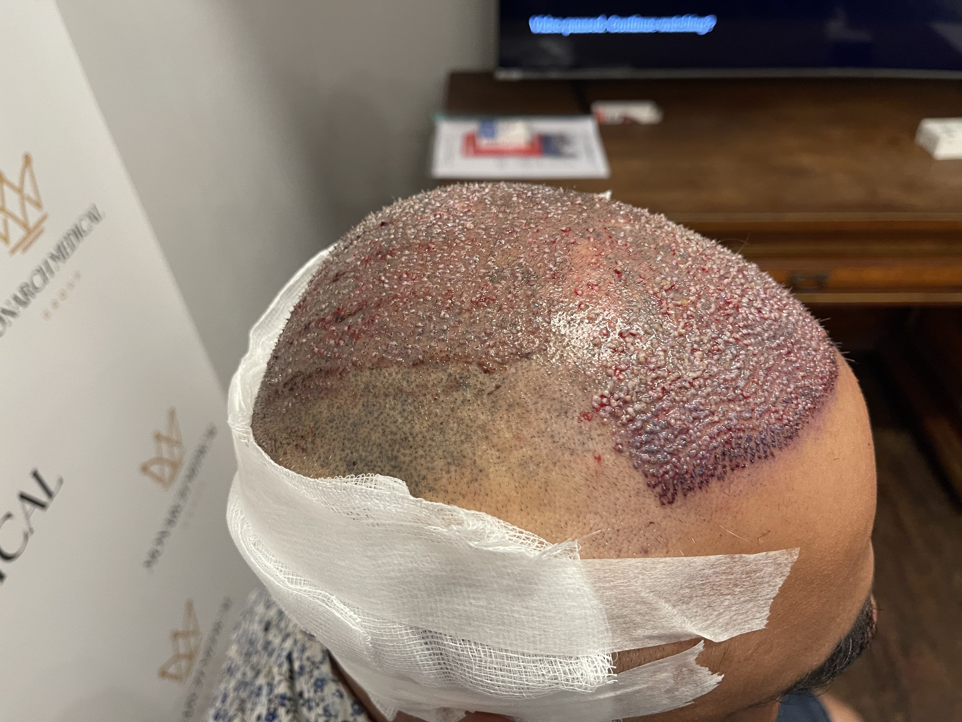Nishant hair transplant result photo 6